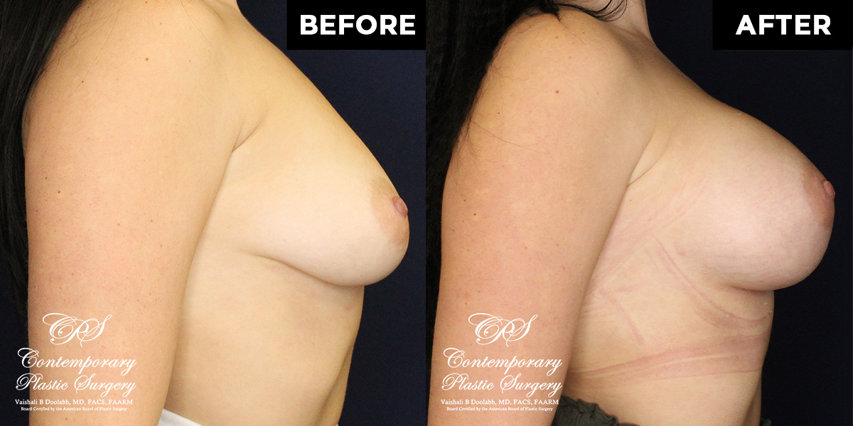 Patient #0412’s Breast Augmentation at Jacksonville plastic surgery clinic, Contemporary Plastic Surgery