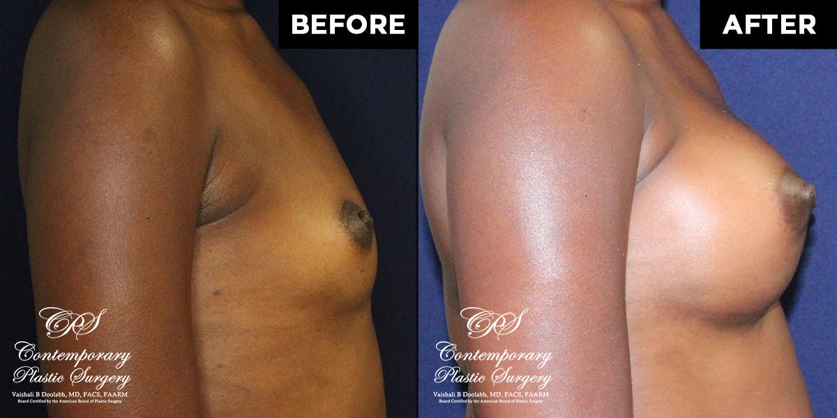Patient #112718’s Breast Augmentation at Jacksonville plastic surgery clinic, Contemporary Plastic Surgery