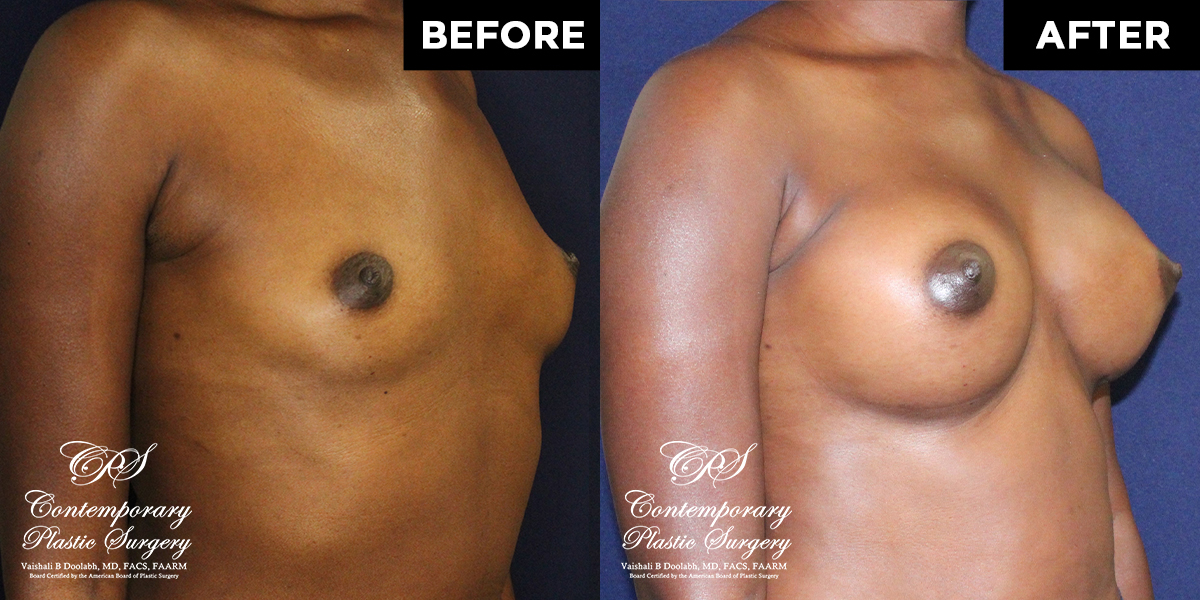 112718-Patient #112718’s Breast Augmentation at Jacksonville plastic surgery clinic, Contemporary Plastic Surgery