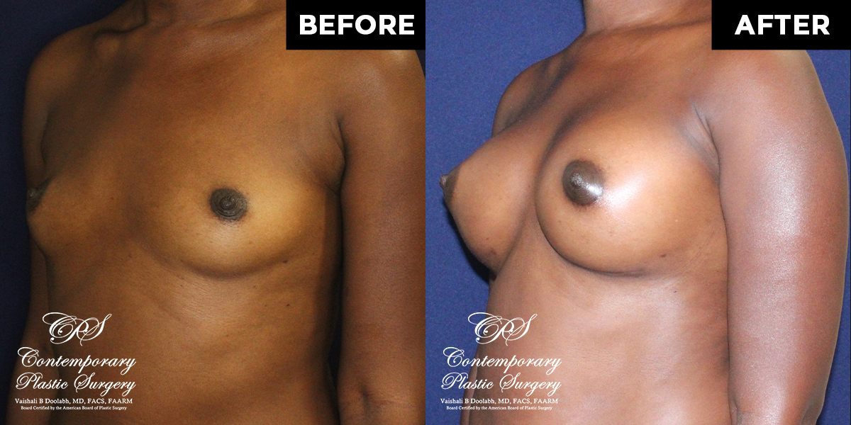 Patient #112718’s Breast Augmentation at Jacksonville plastic surgery clinic, Contemporary Plastic Surgery