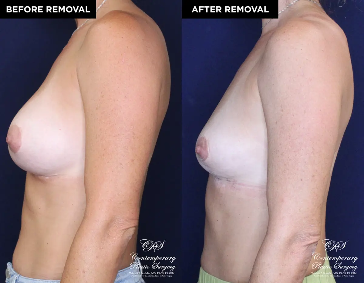 Patient 13478 breast implant removal with replacement at Contemporary Plastic Surgery