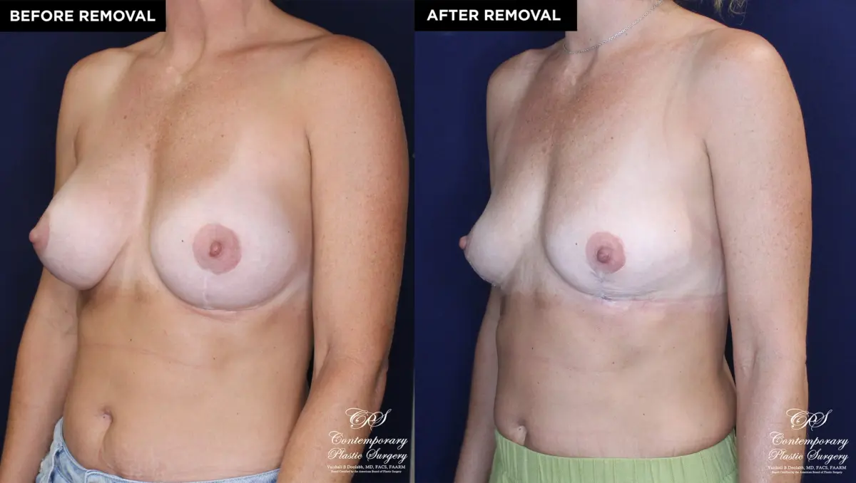 Patient 13478 breast implant removal with replacement at Contemporary Plastic Surgery