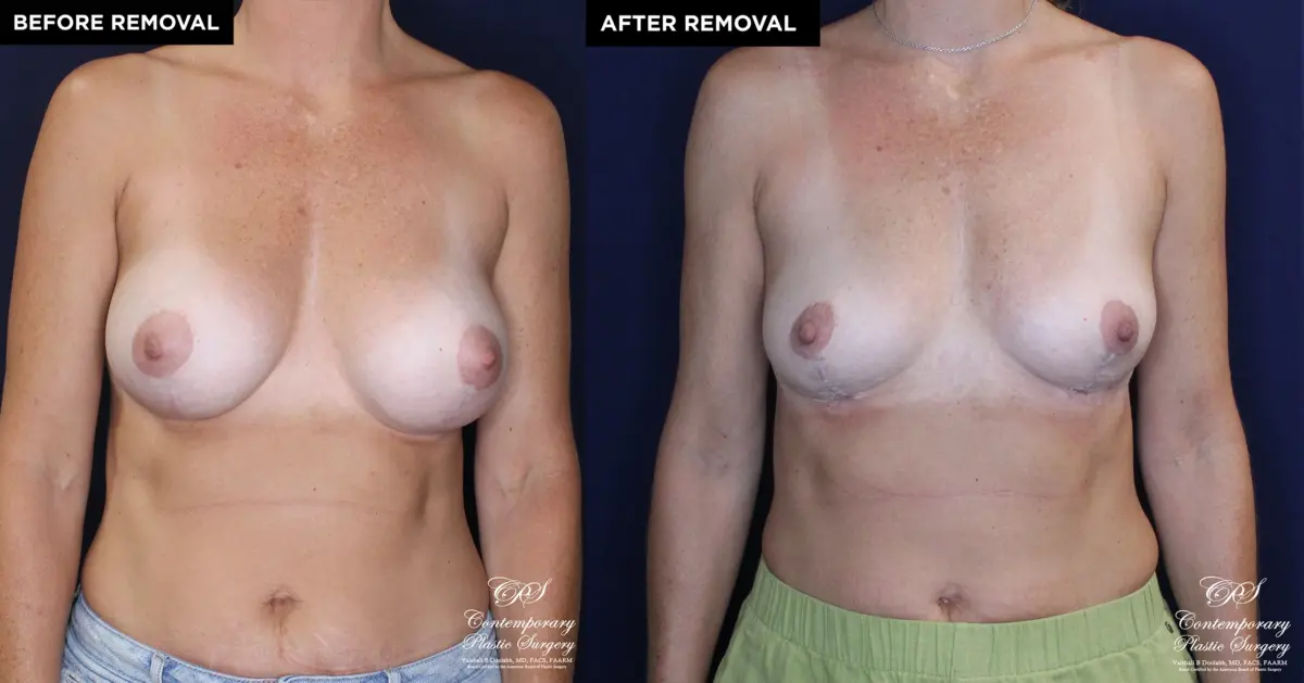 Patient 13478 breast implant removal with replacement at Contemporary Plastic Surgery