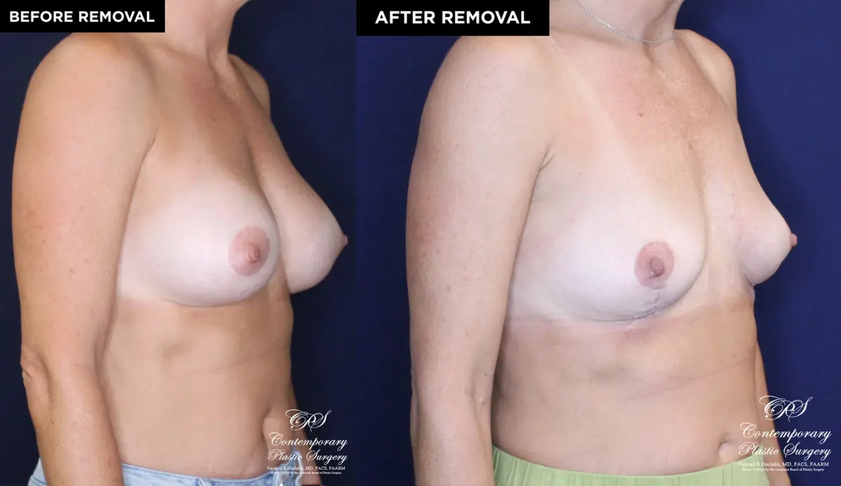 Patient 13478 breast implant removal with replacement at Contemporary Plastic Surgery