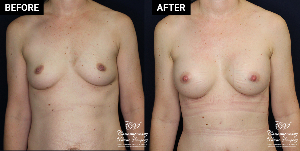breast augmentation patient results at Contemporary Plastic Surgery