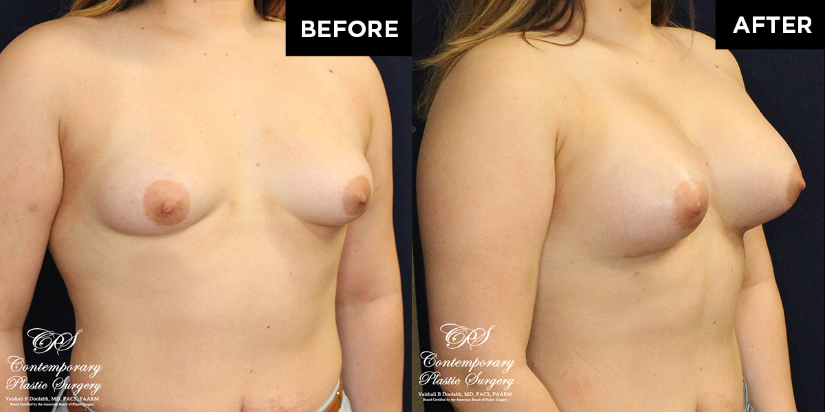 Patient #16669’s Breast Augmentation at Jacksonville plastic surgery clinic, Contemporary Plastic Surgery