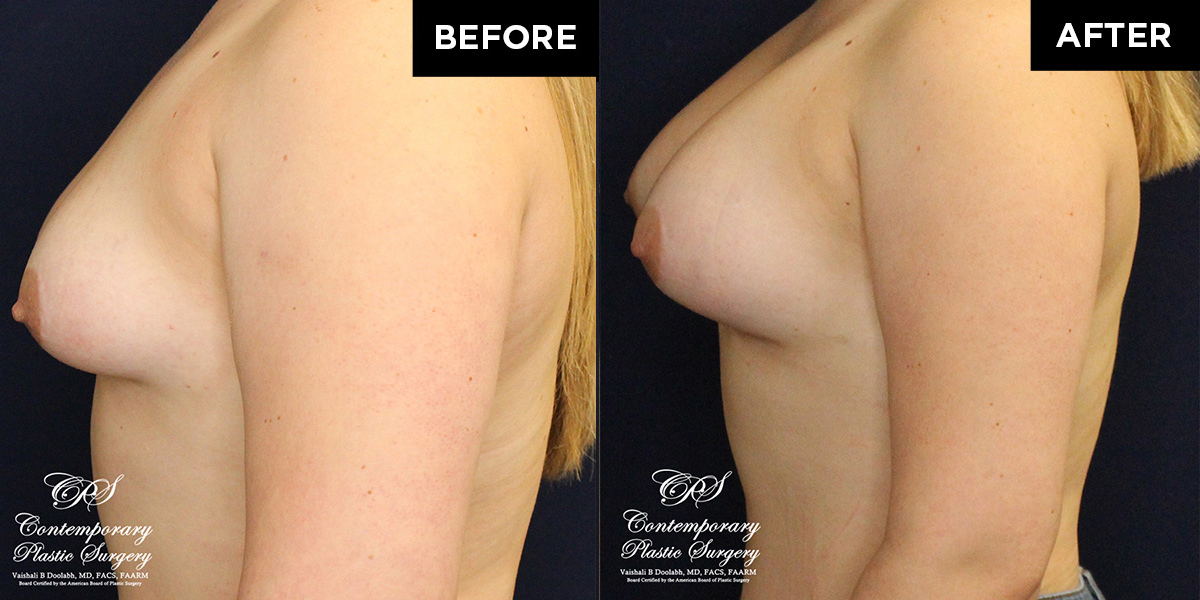 Patient #16669’s Breast Augmentation at Jacksonville plastic surgery clinic, Contemporary Plastic Surgery