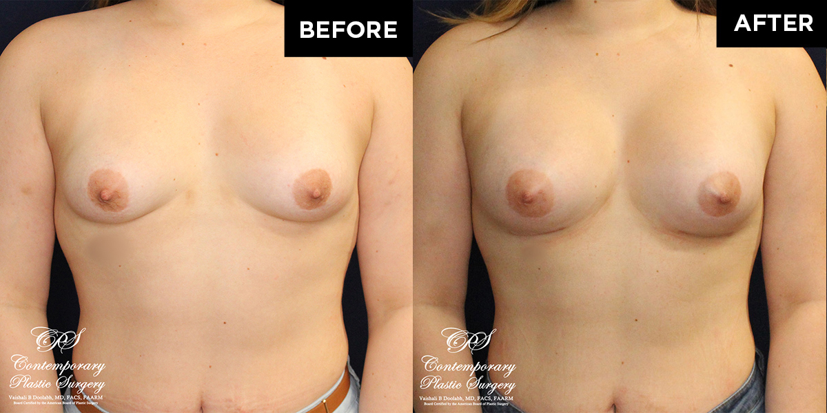 Patient #16669’s Breast Augmentation at Jacksonville plastic surgery clinic, Contemporary Plastic Surgery