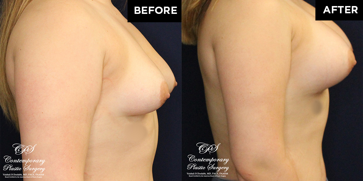 Patient #16669’s Breast Augmentation at Jacksonville plastic surgery clinic, Contemporary Plastic Surgery