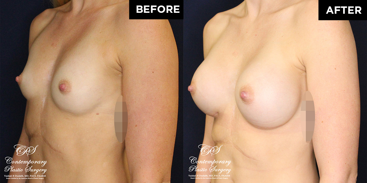 Patient #17162’s Breast Augmentation at Jacksonville plastic surgery clinic, Contemporary Plastic Surgery