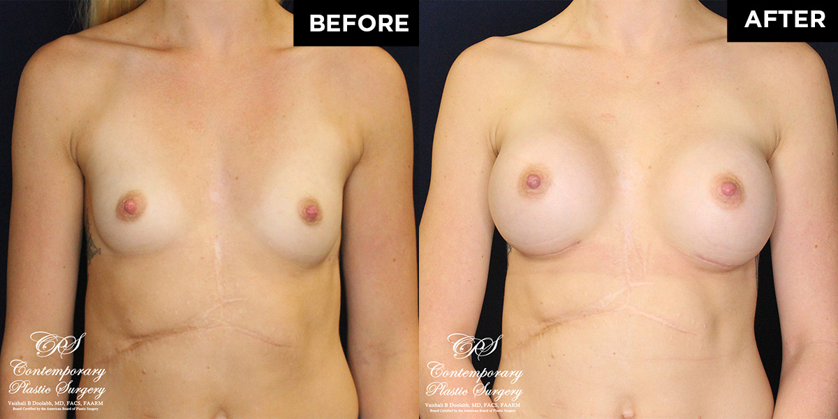 Patient #17162’s Breast Augmentation at Jacksonville plastic surgery clinic, Contemporary Plastic Surgery