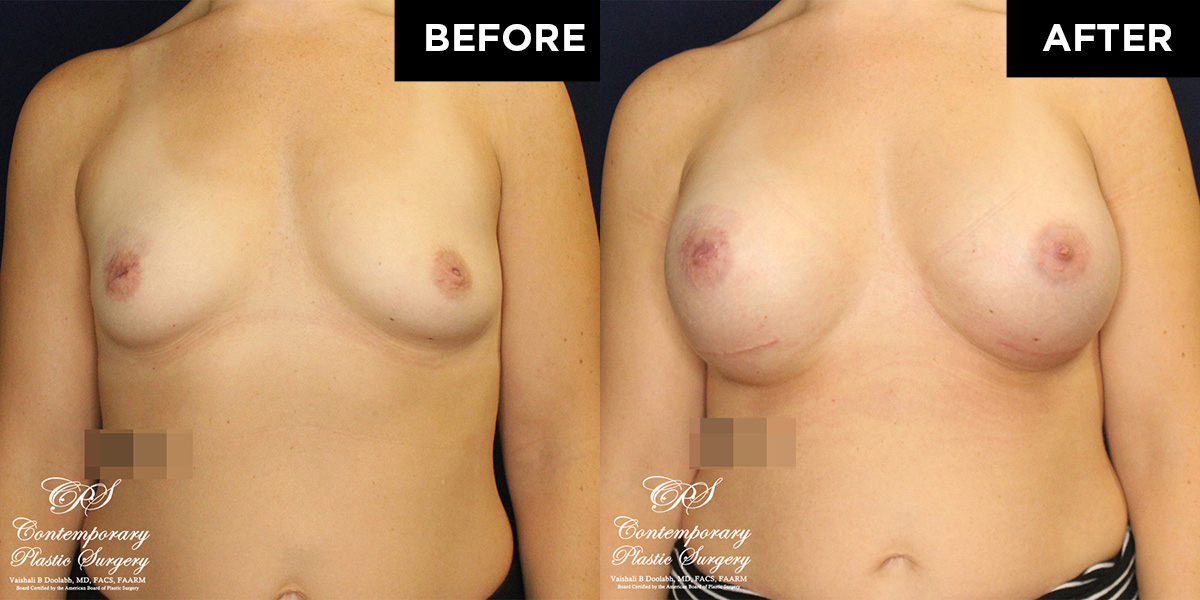 Patient #17360’s Breast Augmentation at Jacksonville plastic surgery clinic, Contemporary Plastic Surgery