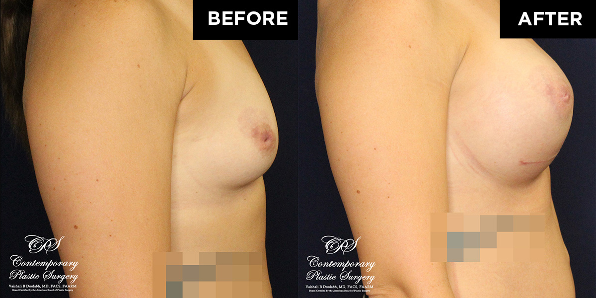 Patient #17360’s Breast Augmentation at Jacksonville plastic surgery clinic, Contemporary Plastic Surgery
