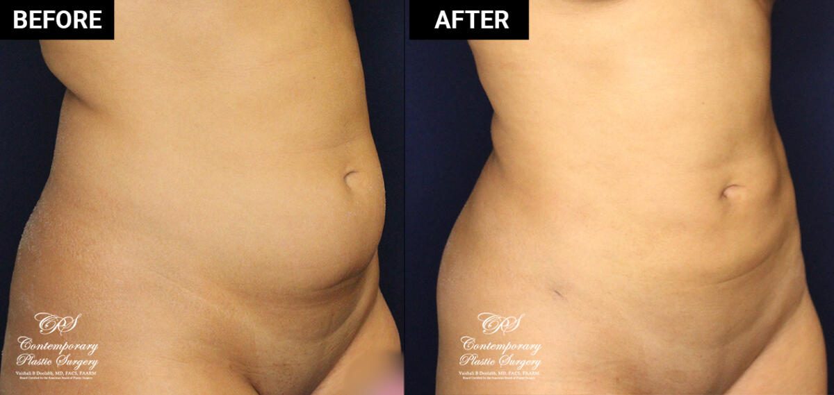 liposuction and skin tightening before and after