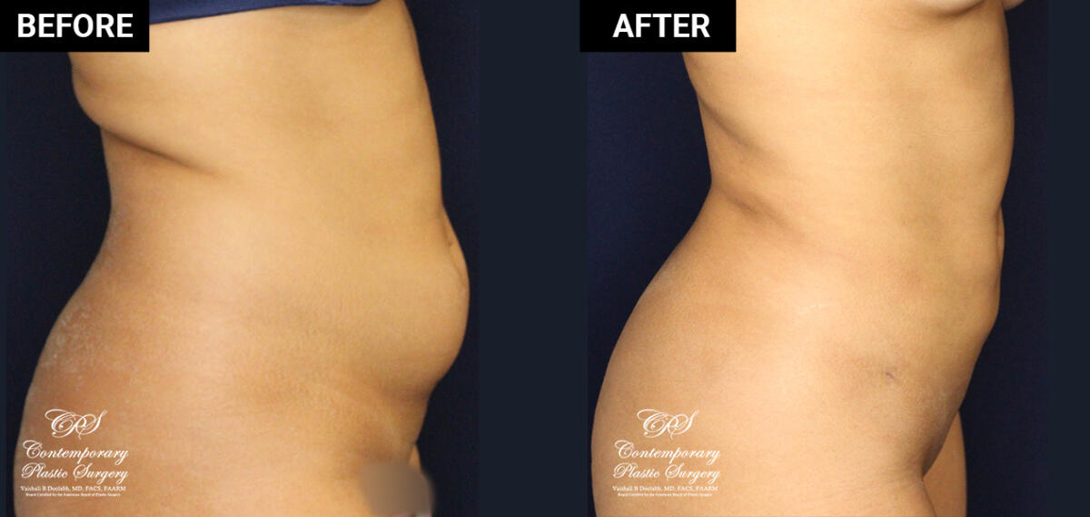 liposuction and Renuvion® contouring before and after