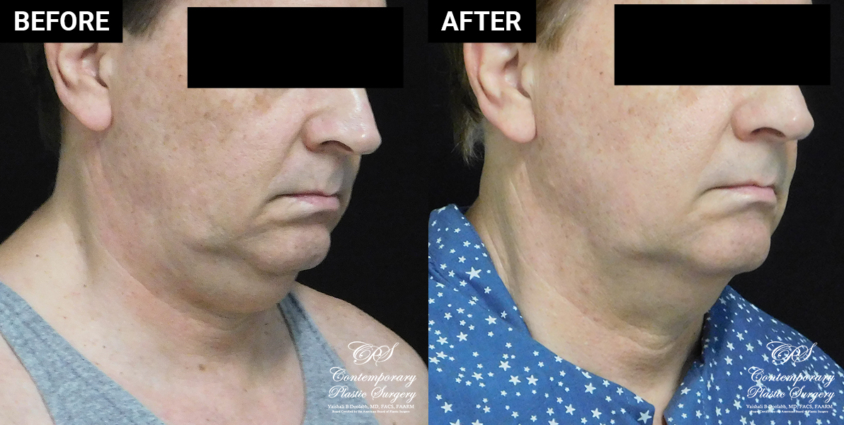 Patient's before and after results with CoolSculpting at Contemporary Plastic Surgery