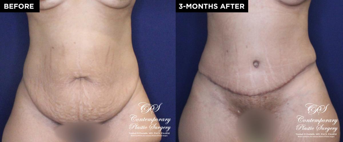 Patient 18489 tummy tuck before and after results at Contemporary Plastic Surgery 