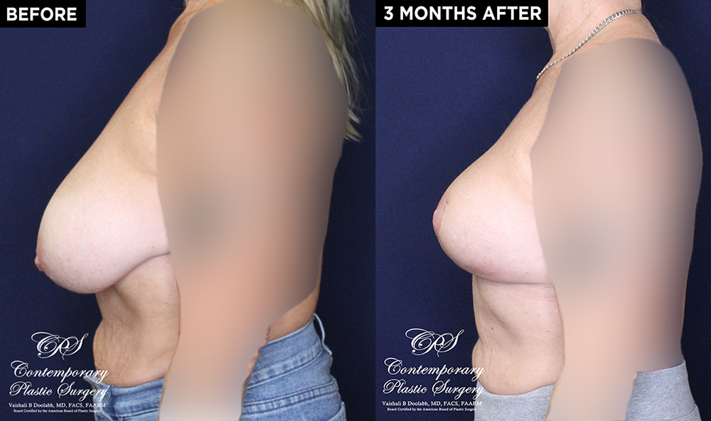 Patient 20036's breast reduction before and after results at Contemporary Plastic Surgery