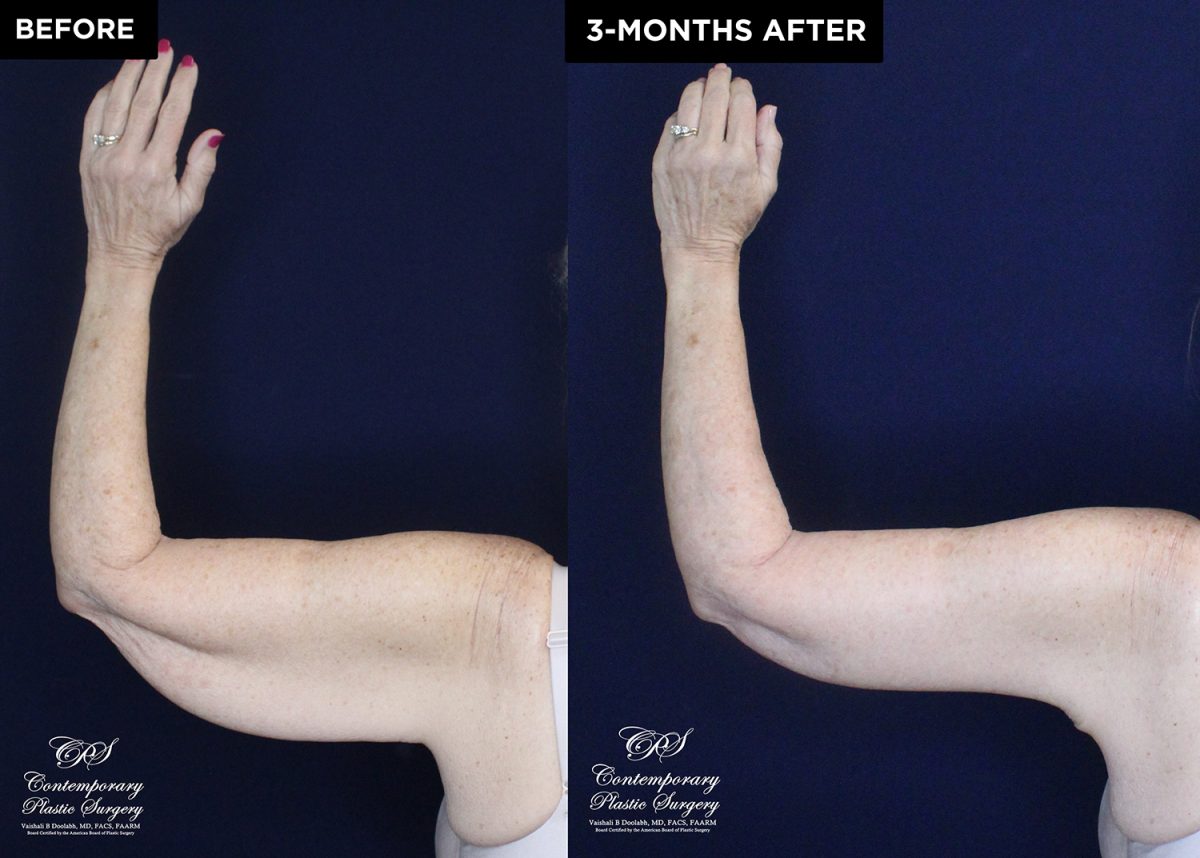 upper arm lift patient 20557 before and after results at Contemporary Plastic Surgery