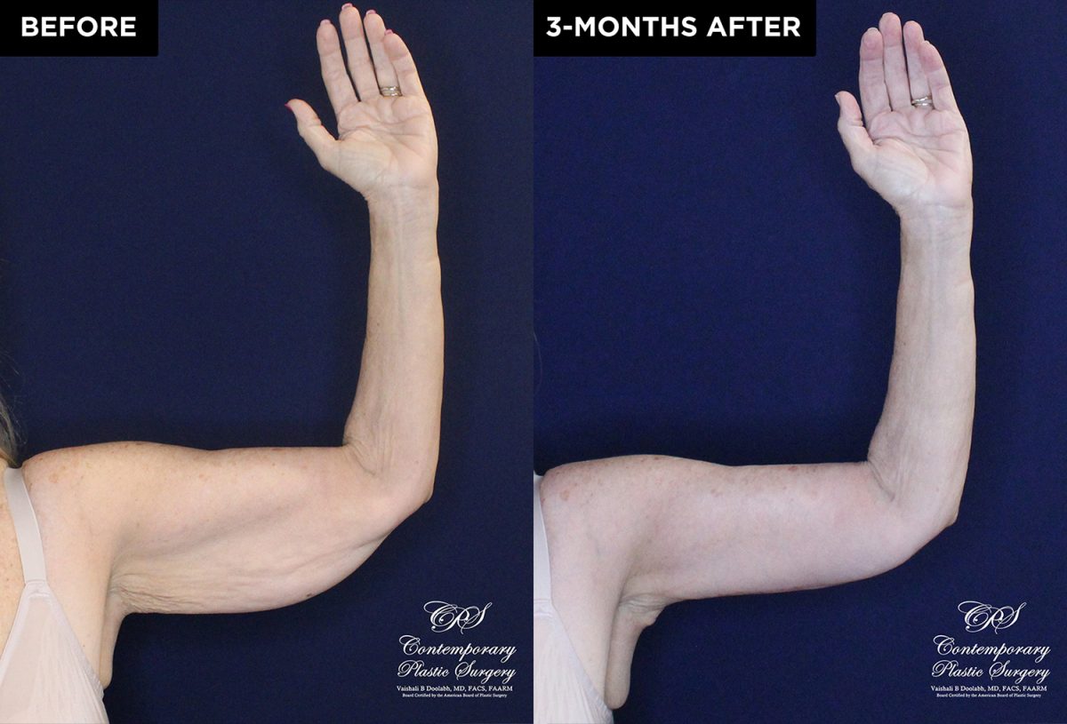 upper arm lift patient 20557 before and after results at Contemporary Plastic Surgery