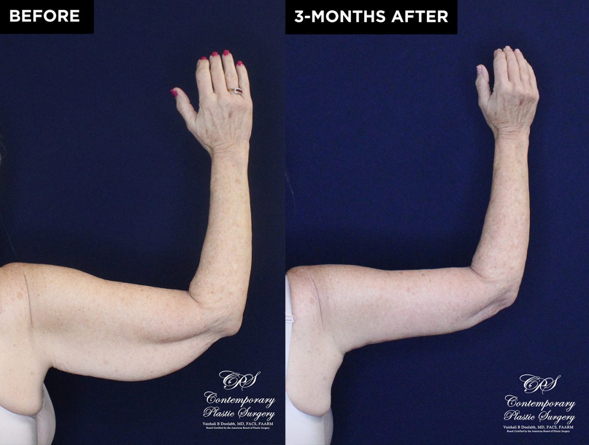 upper arm lift patient 20557 before and after results at Contemporary Plastic Surgery