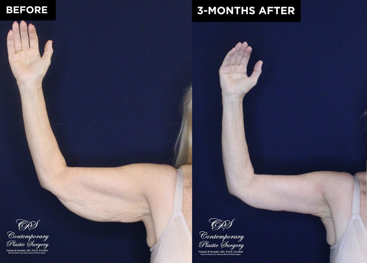 upper arm lift patient 20557 before and after results at Contemporary Plastic Surgery