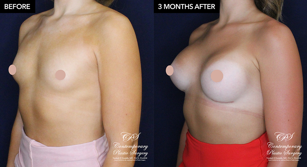 patient 20920 breast augmentation results at Contemporary Plastic Surgery