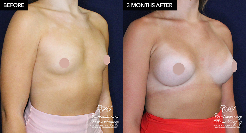patient 20920 breast augmentation results at Contemporary Plastic Surgery