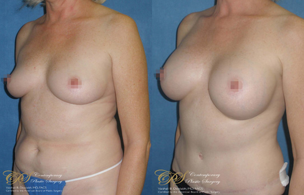 Patient #2919’s Breast Augmentation at Jacksonville plastic surgery clinic, Contemporary Plastic Surgery