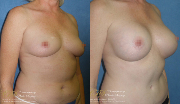 Patient #2919’s Breast Augmentation at Jacksonville plastic surgery clinic, Contemporary Plastic Surgery