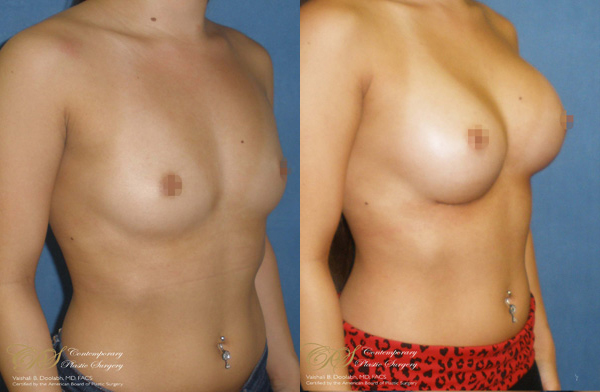 Patient #2924’s Breast Augmentation at Jacksonville plastic surgery clinic, Contemporary Plastic Surgery