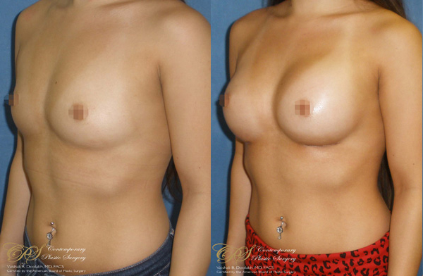 Patient #2924’s Breast Augmentation at Jacksonville plastic surgery clinic, Contemporary Plastic Surgery
