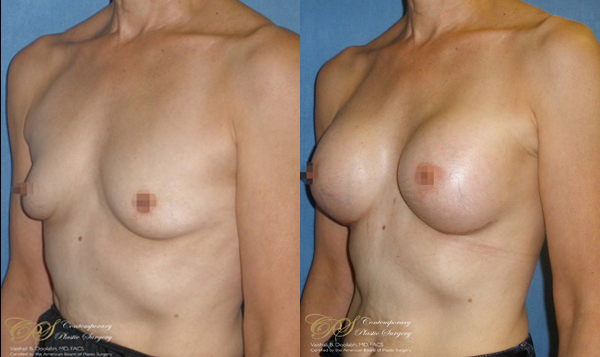 Patient #2929’s Breast Augmentation at Jacksonville plastic surgery clinic, Contemporary Plastic Surgery