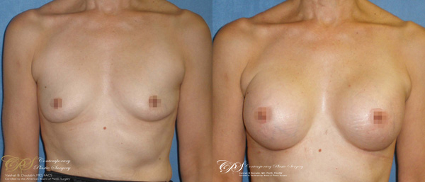 Patient #2929’s Breast Augmentation at Jacksonville plastic surgery clinic, Contemporary Plastic Surgery