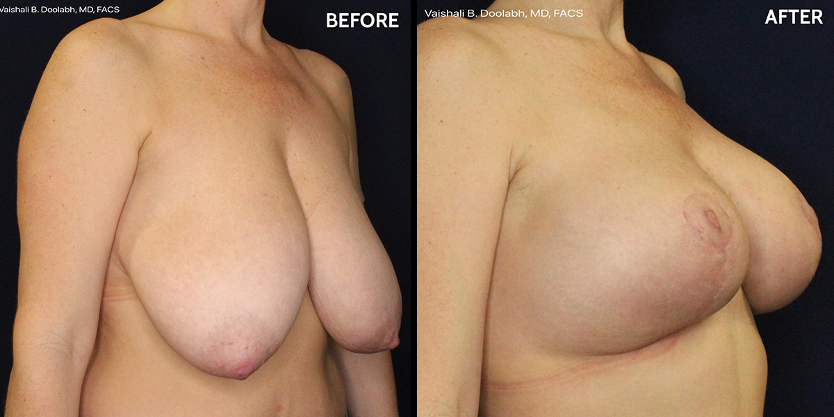 44-year-old patient's Breast Augmentation at Jacksonville plastic surgery clinic, Contemporary Plastic Surgery
