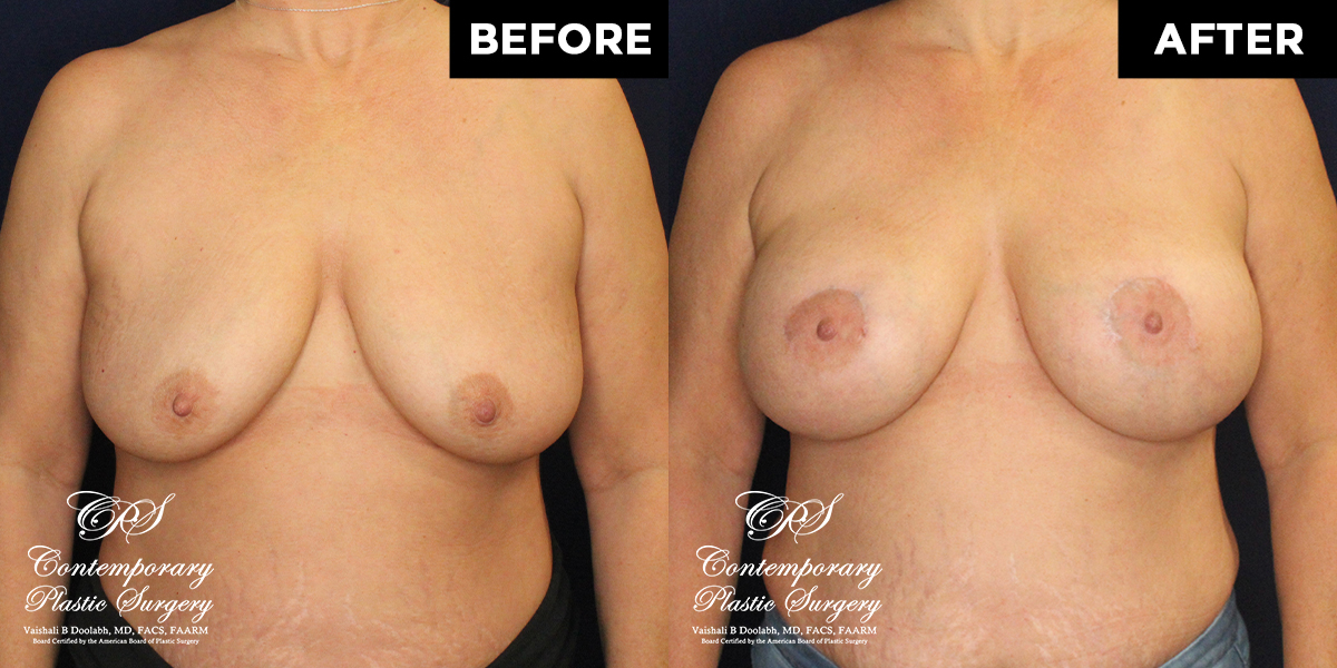 Patient #7819’s Breast Augmentation at Jacksonville plastic surgery clinic, Contemporary Plastic Surgery