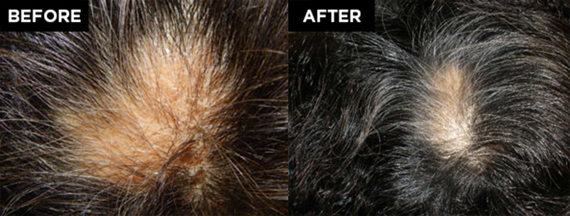 hair restoration patient before and after