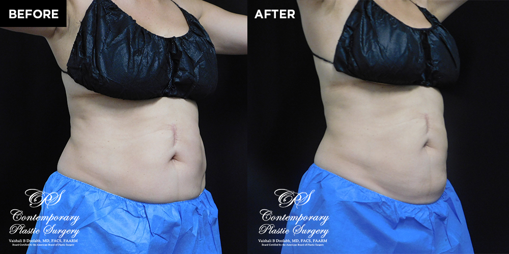 Patient's before and after results with CoolSculpting at Contemporary Plastic Surgery