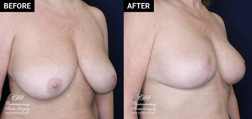 breast reduction before and after patient results at Contemporary Plastic Surgery