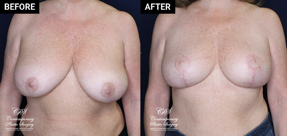 breast reduction patient before and after results at Contemporary Plastic Surgery