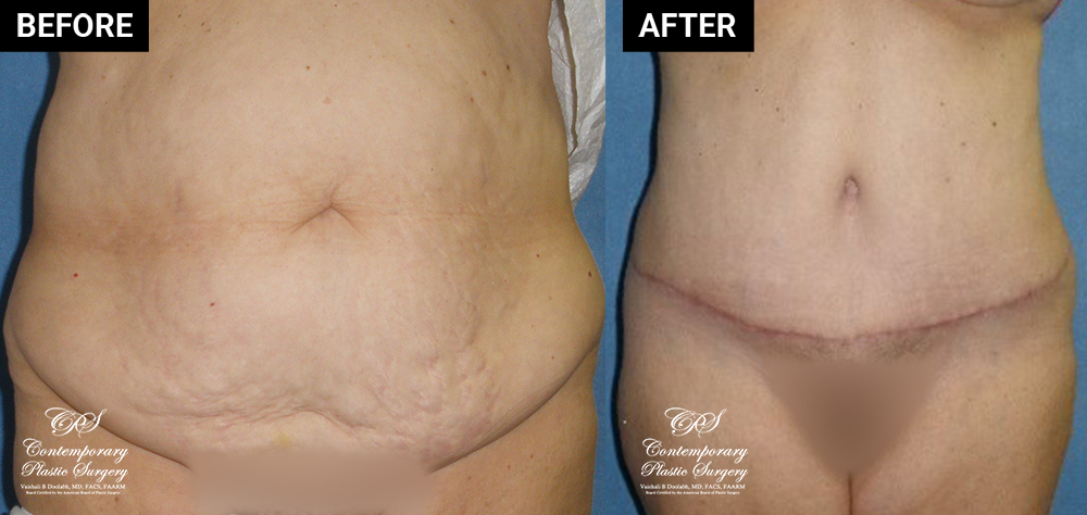 tummy tuck patient before and after results at Contemporary Plastic Surgery