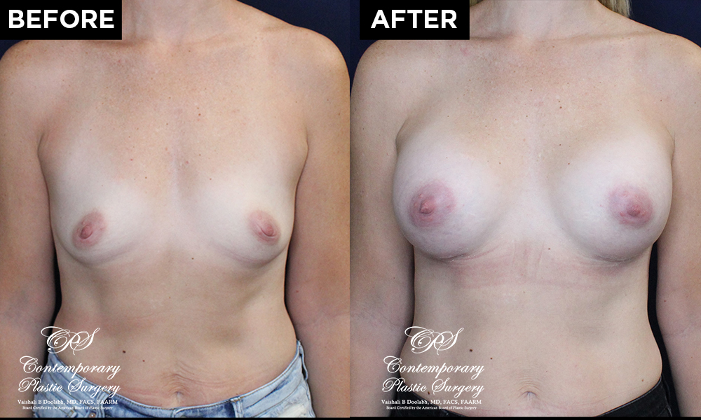 breast augmentation patient results at Contemporary Plastic Surgery
