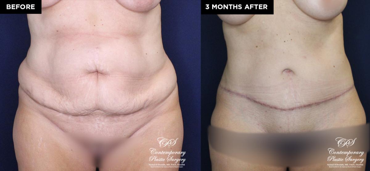 liposuction and tummy tuck before and after results at Contemporary Plastic Surgery