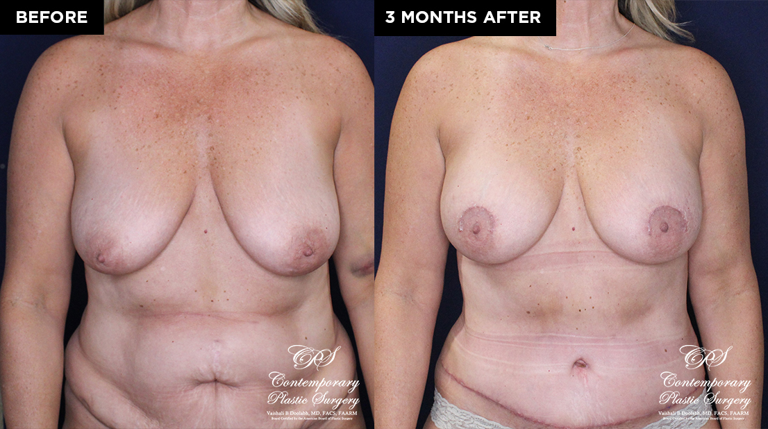 breast augmentation before and after results at Contemporary Plastic Surgery