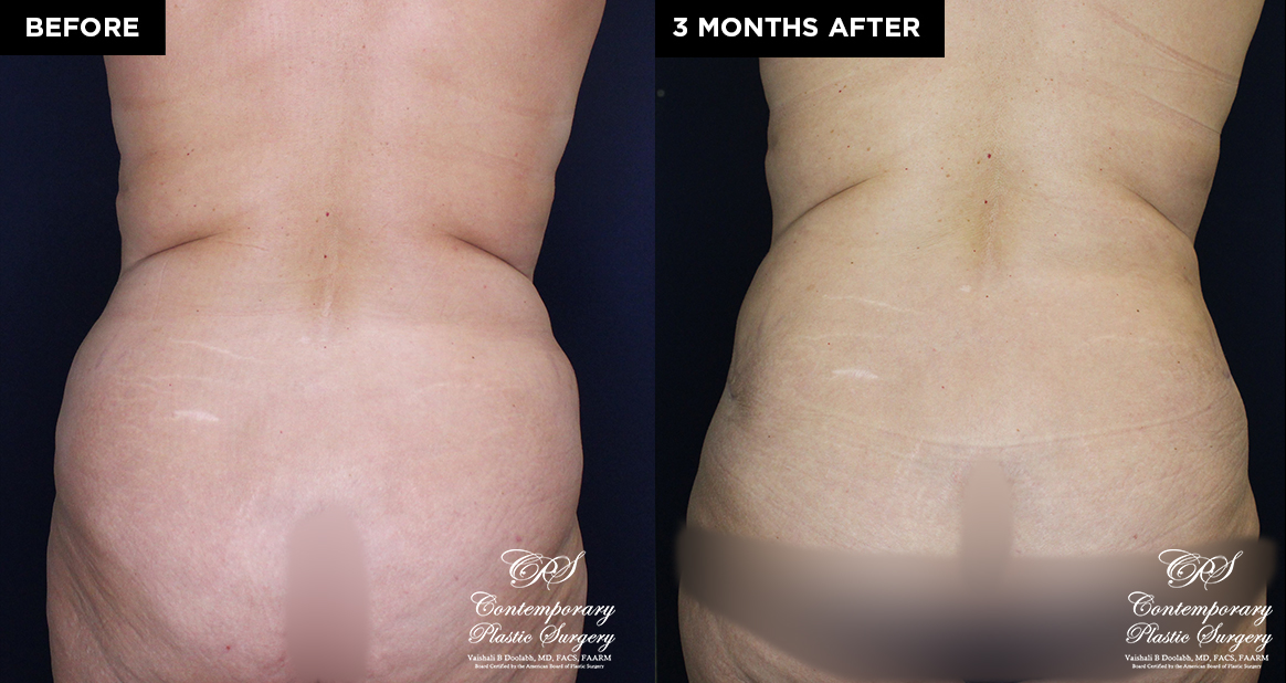 liposuction and tummy tuck before and after results at Contemporary Plastic Surgery