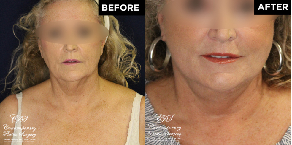 lower face and neck lift