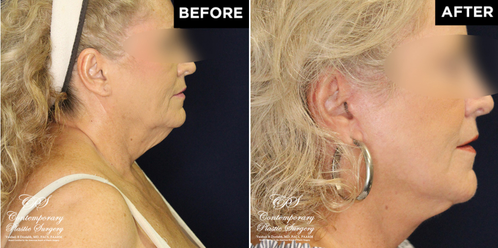 lower face and neck lift