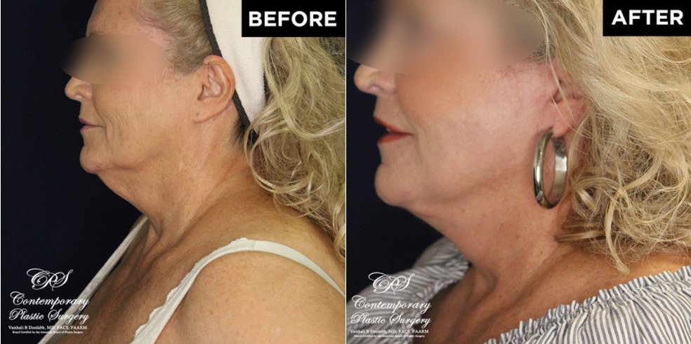 lower face and neck lift