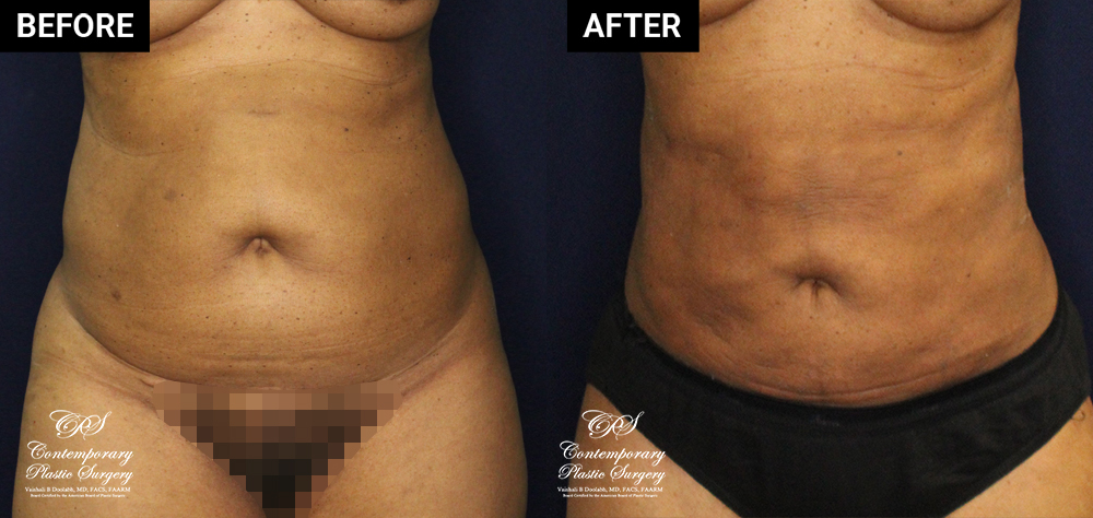 liposuction patient before and after results at Contemporary Plastic Surgery