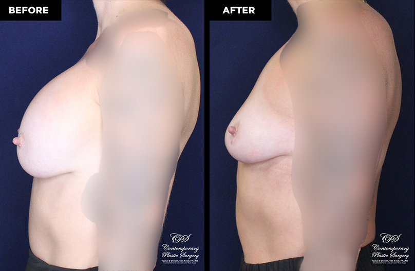 breast implant removal without replacement at Contemporary Plastic Surgery